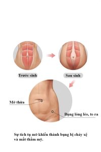 Đai Định Hình Bụng Sau Sinh Loại Nào Tốt Nhất